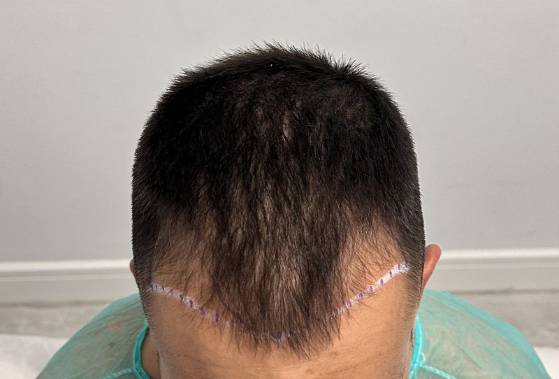 Diseño de la línea frontal marcada antes del injerto capilar