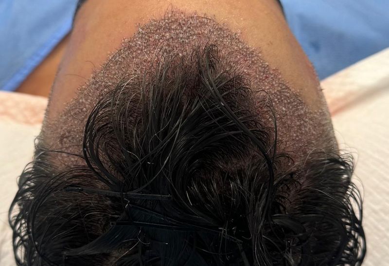 Línea frontal recién implantada tras una intervención de injerto capilar